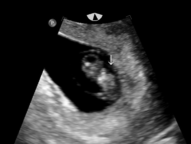 Sonogram Scan 1